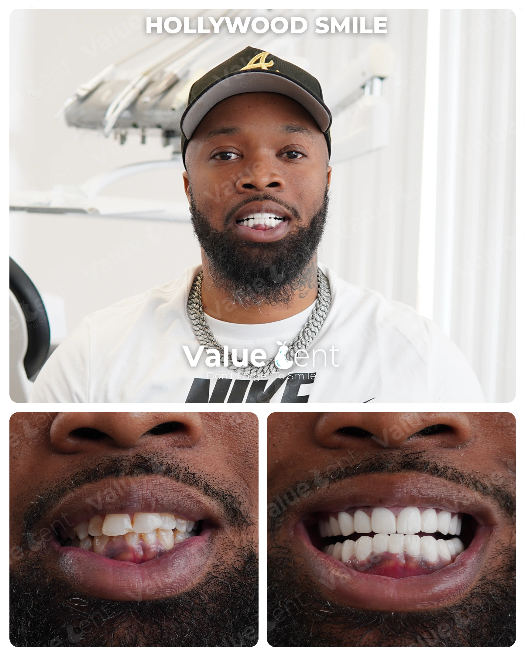 Hollywood Smile Patient ValueDent