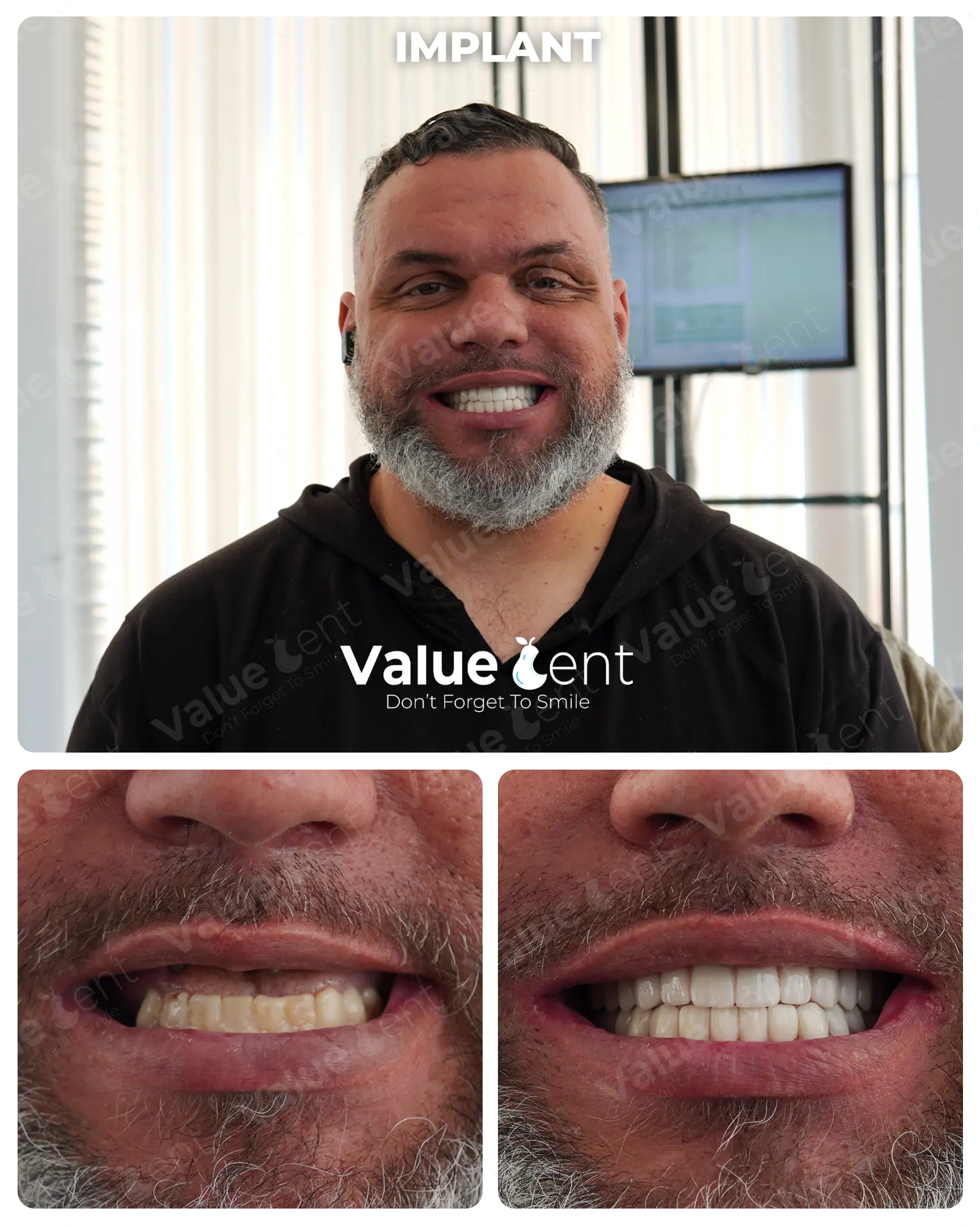 Full Mouth Implants Patient ValueDent