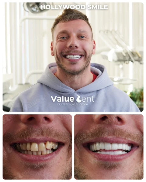 Hollywood Smile