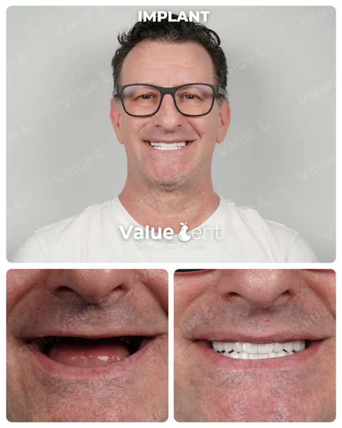 Implants