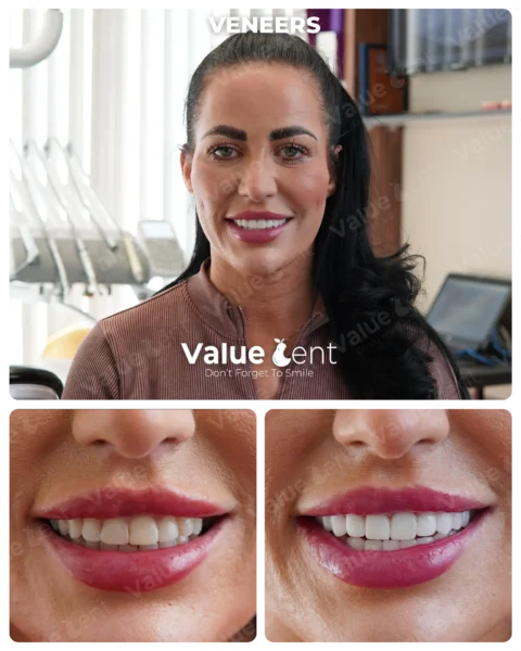 Veneers