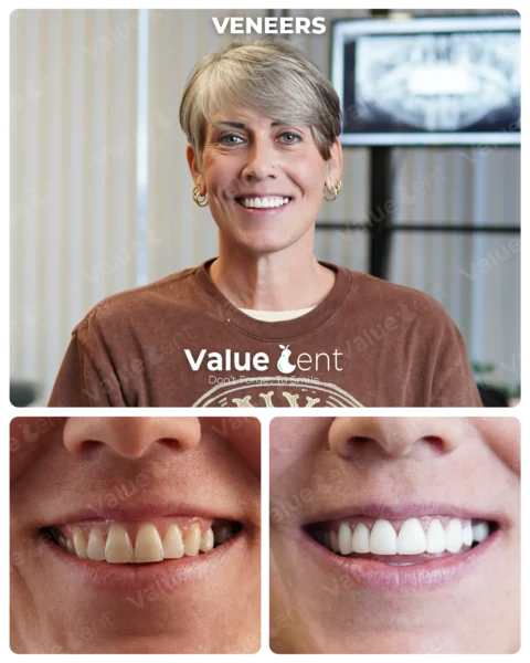 Veneers
