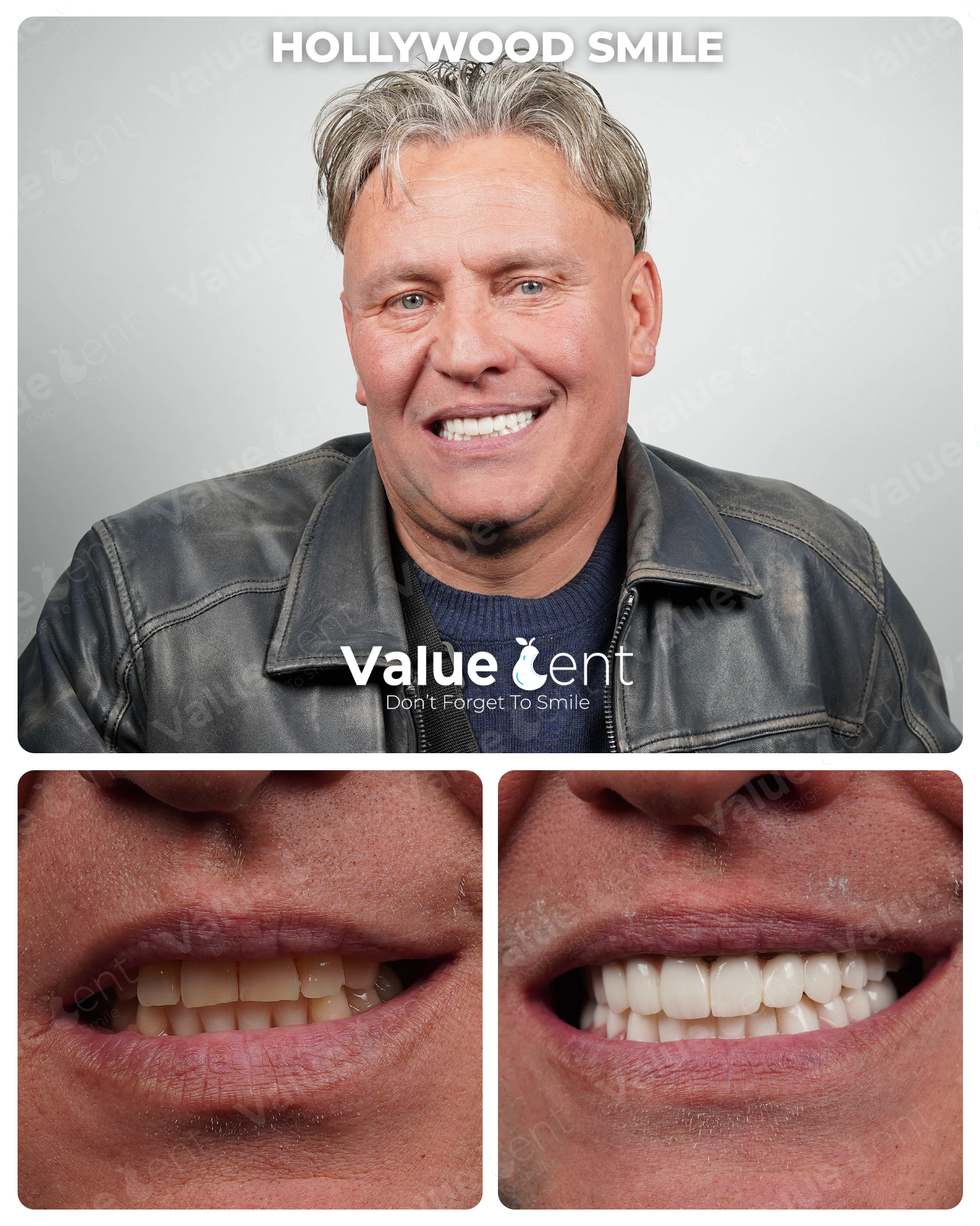 Hollywood Smile Patient ValueDent