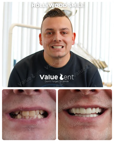 Hollywood Smile