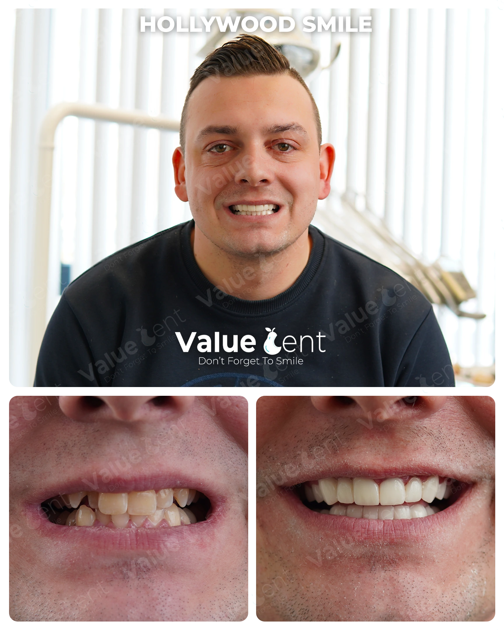 Hollywood Smile Patient ValueDent