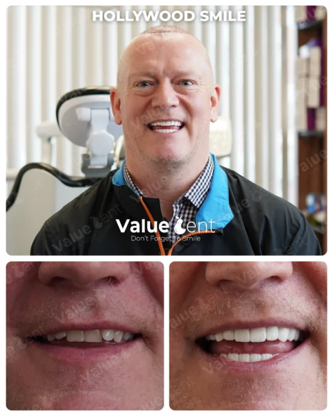 Hollywood Smile