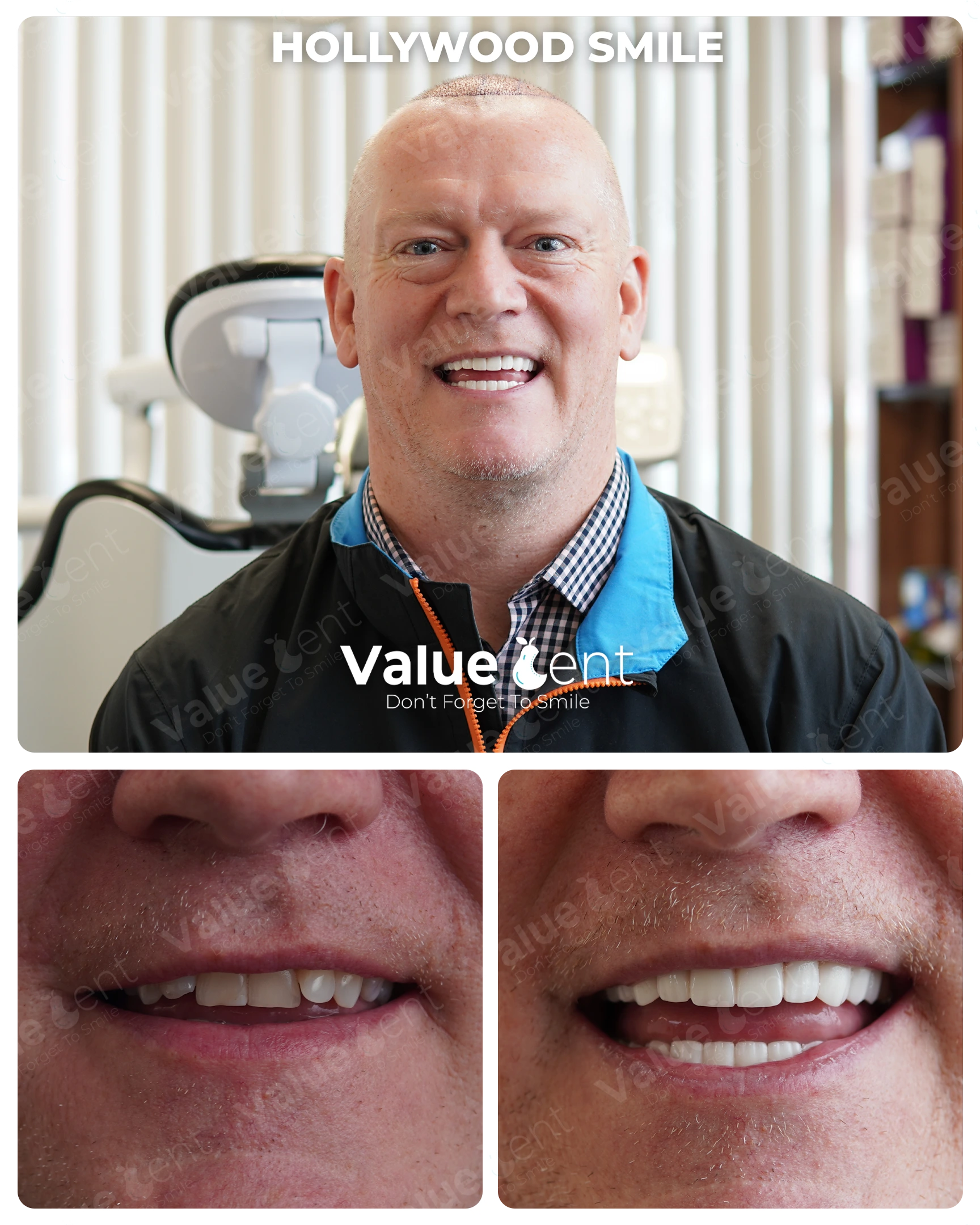 Hollywood Smile Patient ValueDent