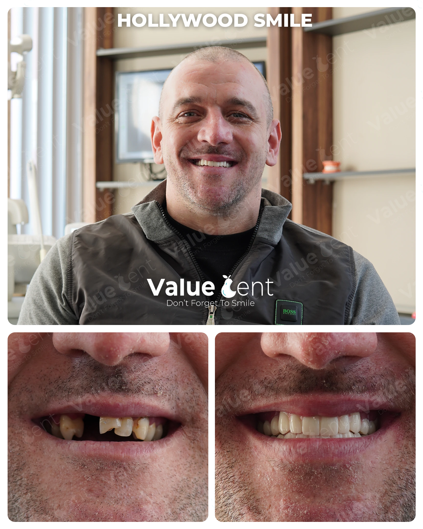 Hollywood Smile Patient ValueDent