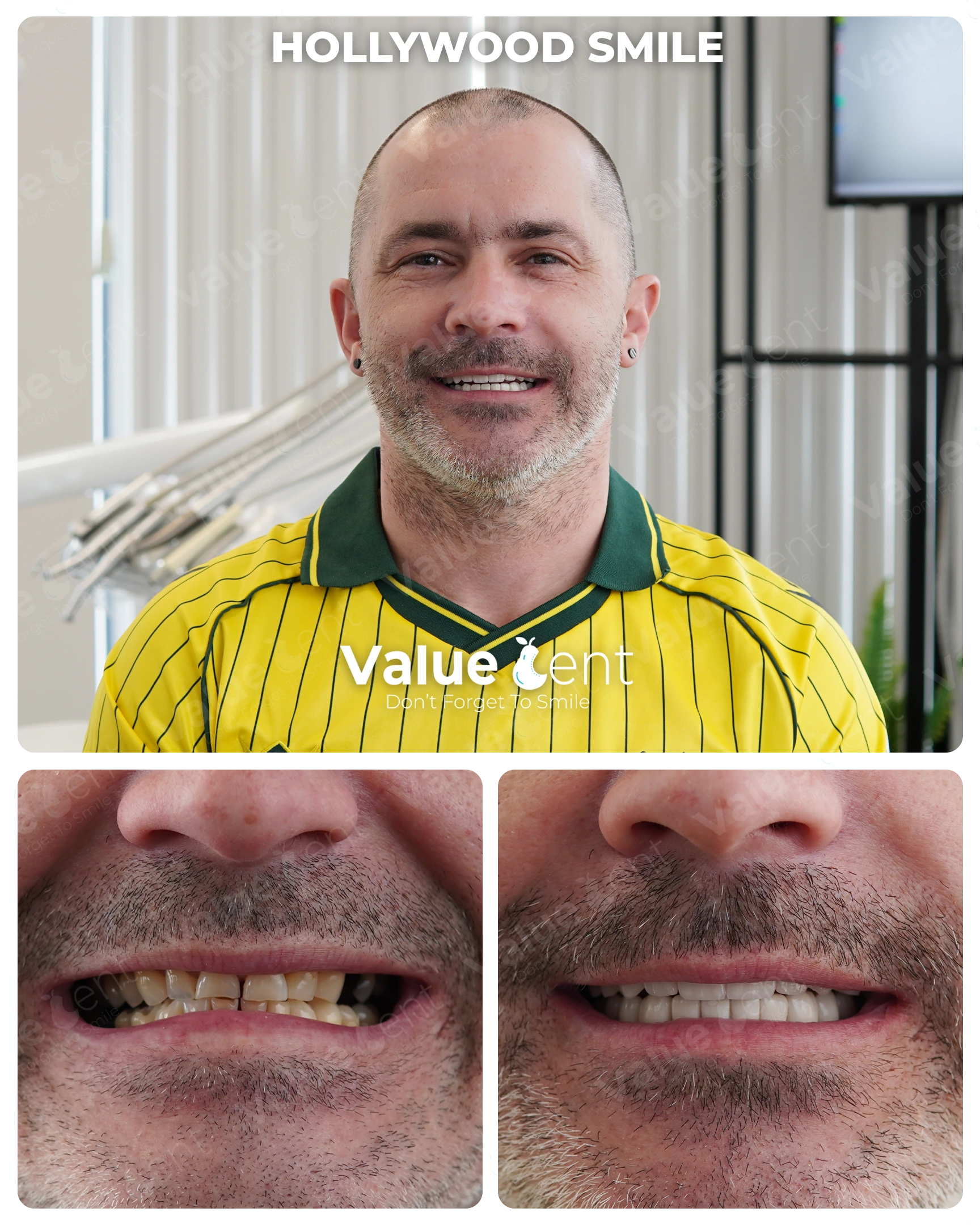 Hollywood Smile Patient ValueDent
