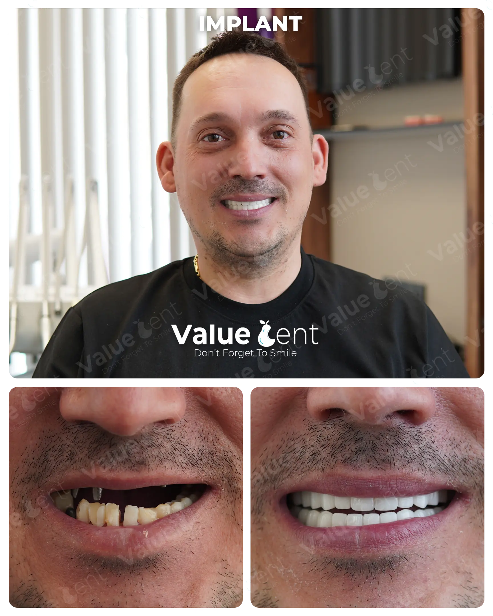 Full Mouth Implants Patient ValueDent