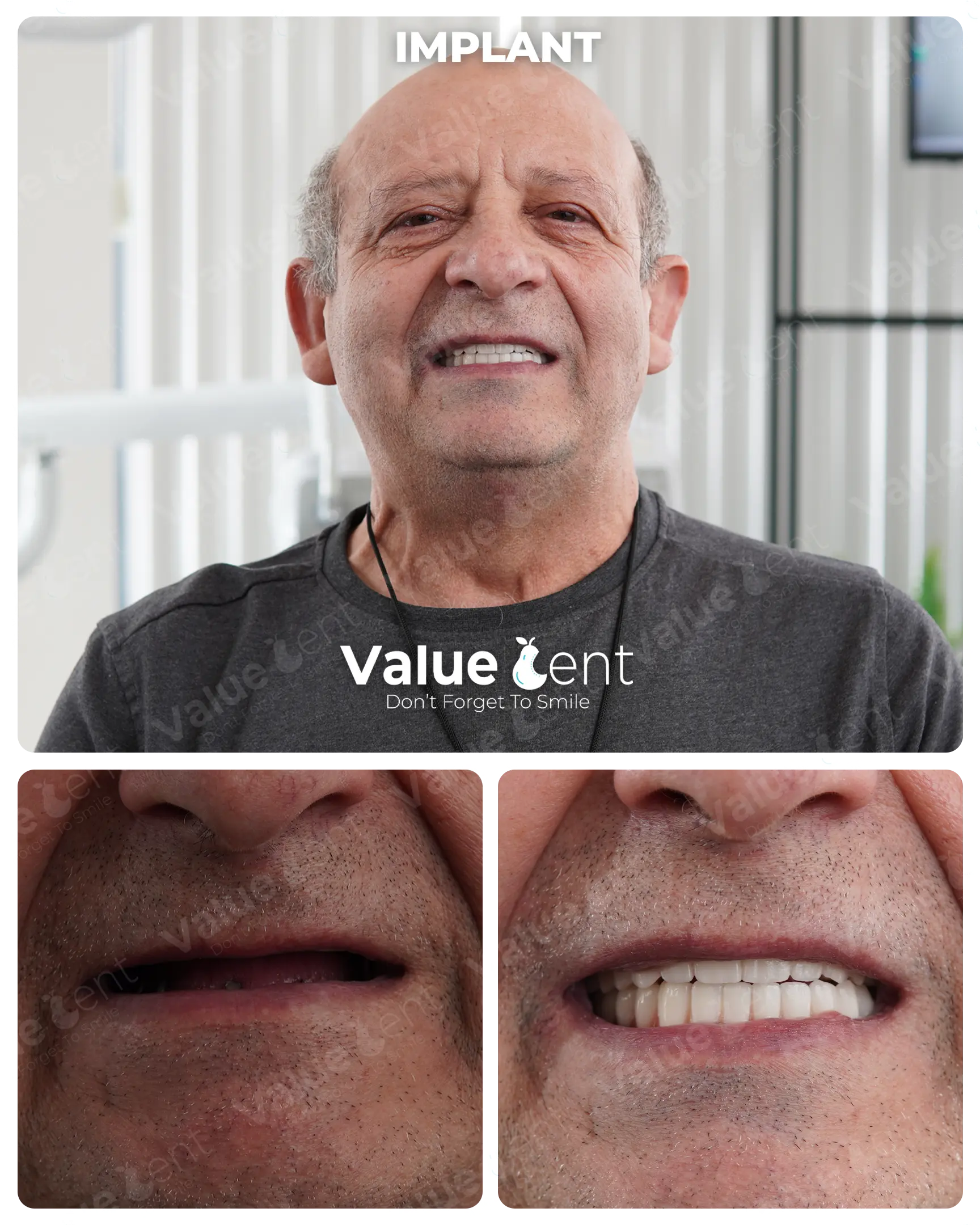 Full Mouth Implants Patient ValueDent