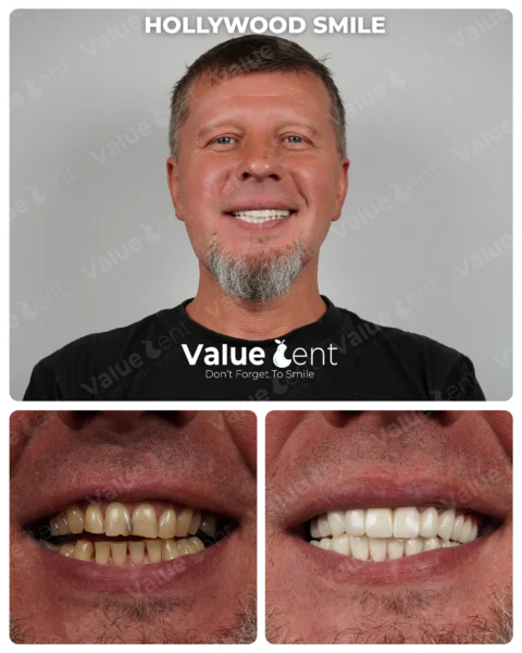 Hollywood Smile