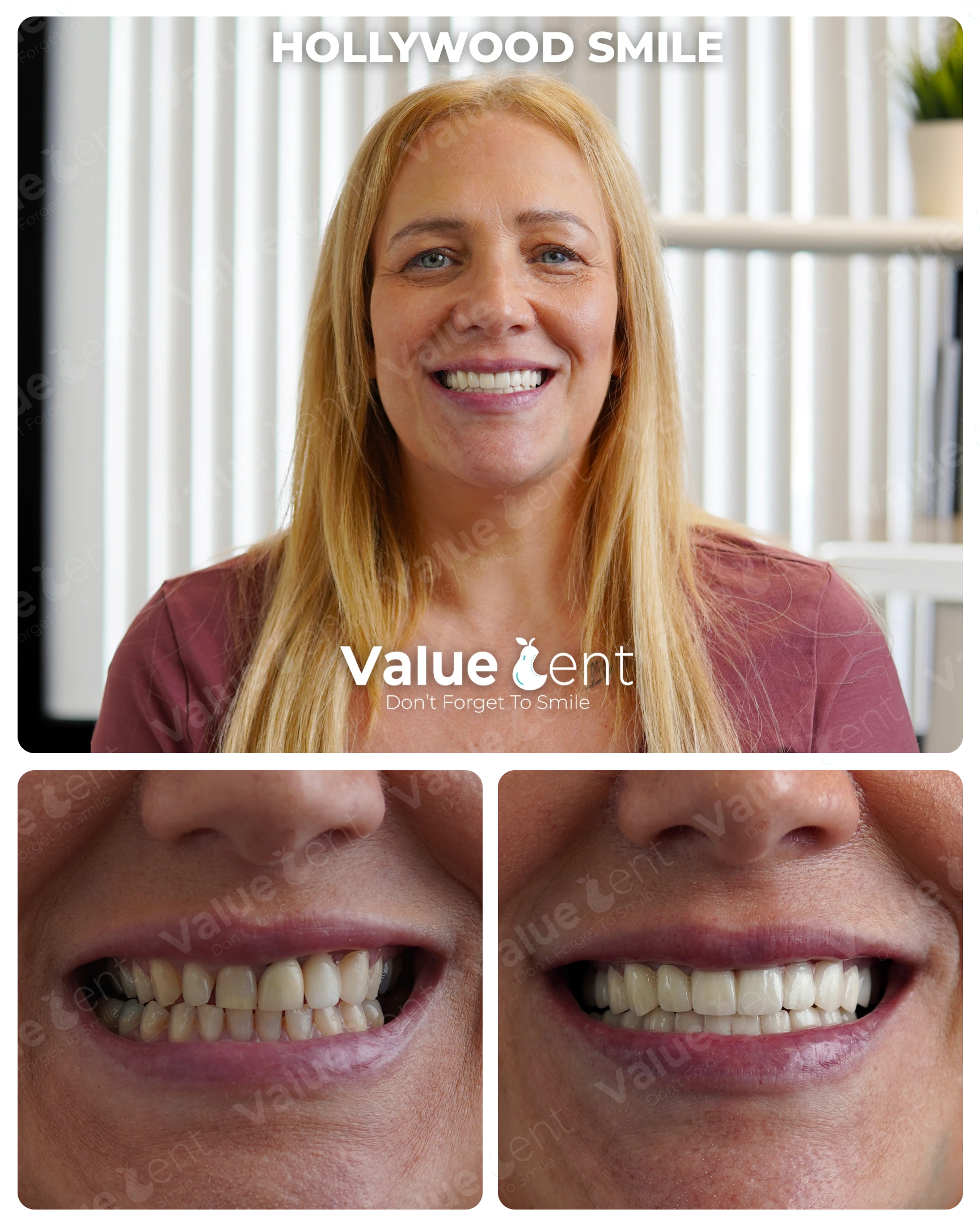 Hollywood Smile Patient ValueDent