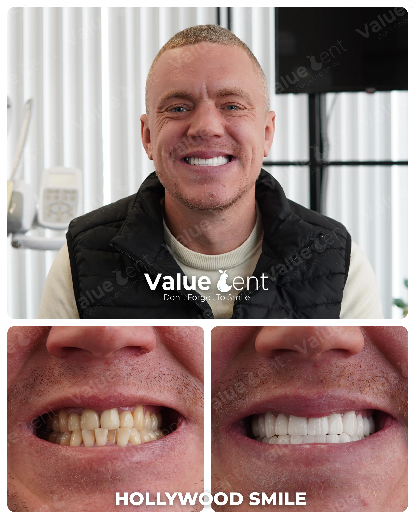 Hollywood Smile Patient ValueDent